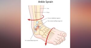 Read more about the article Ankle Sprains: A Physiotherapy-Led Strategy for Acute Management and Reinjury Prevention