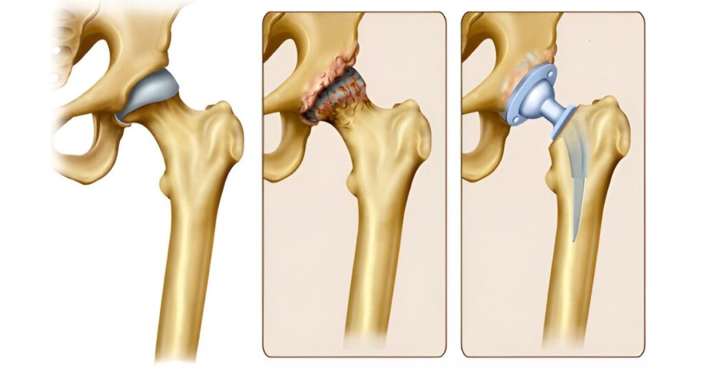 Hip Osteoarthritis: A Physiotherapy-Driven Model for Conservative Management