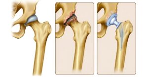 Read more about the article Hip Osteoarthritis: A Physiotherapy-Driven Model for Conservative Management
