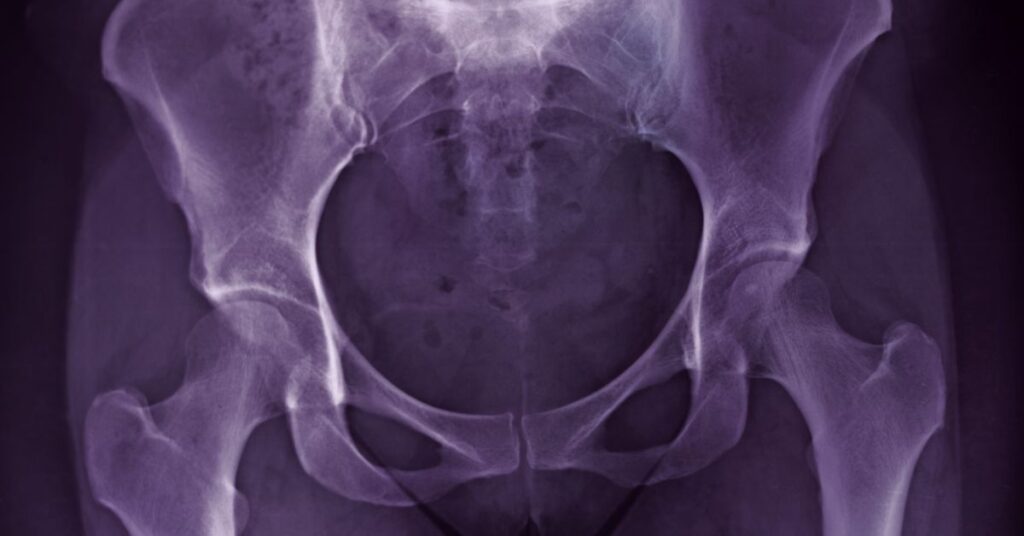 Hip Osteoarthritis: Understanding the Pain and Finding Relief Without Surgery