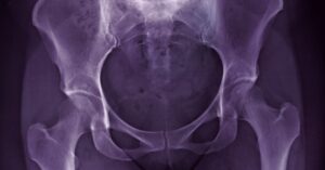 Read more about the article Hip Osteoarthritis: Understanding the Pain and Finding Relief Without Surgery