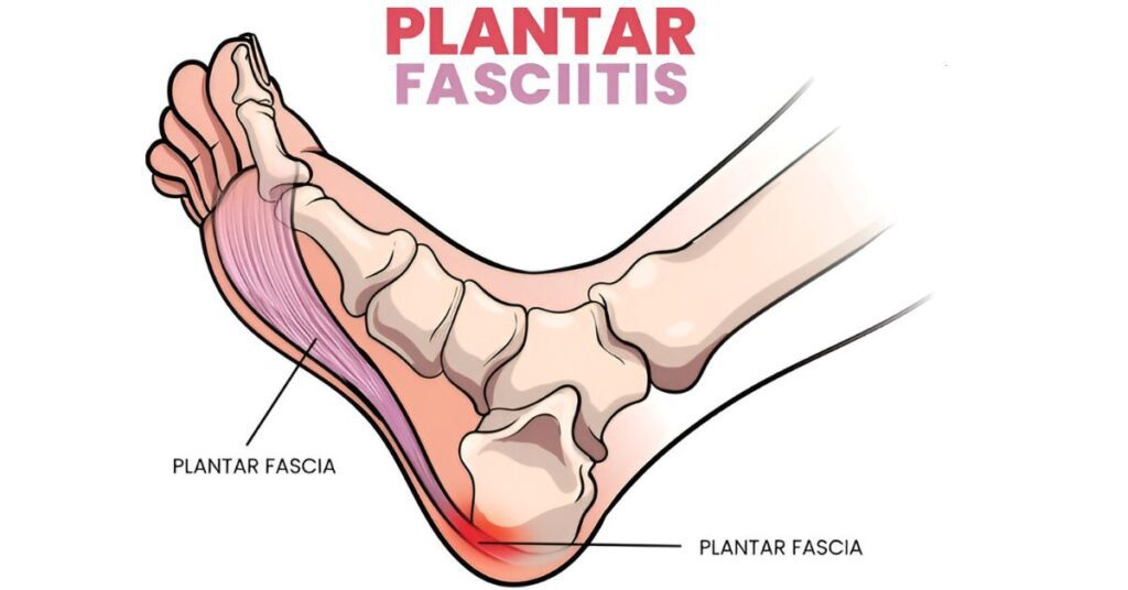 Plantar Fasciitis: A Physiotherapist’s Perspective on Evidence-Based Conservative Care