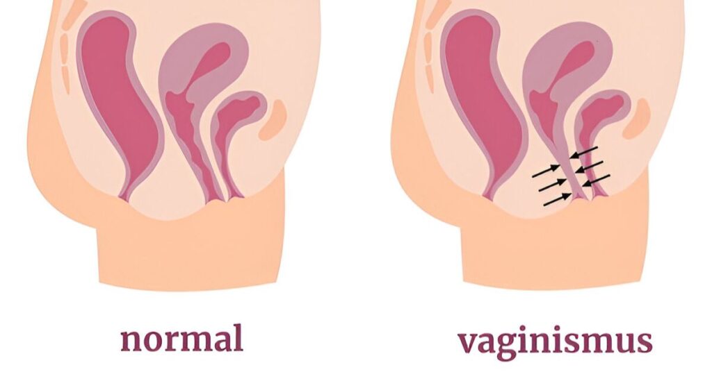Vaginismus: An Underrecognized Condition and the Role of Physiotherapy in Evidence-Based Management